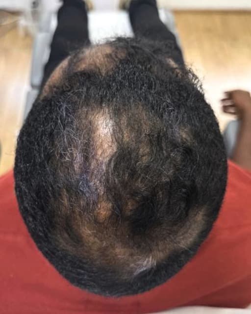 Case 02 after Alopecia care