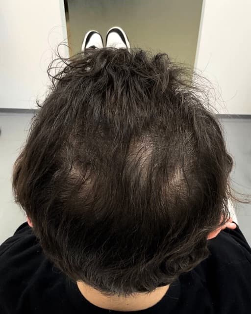 Case 03 after Alopecia care