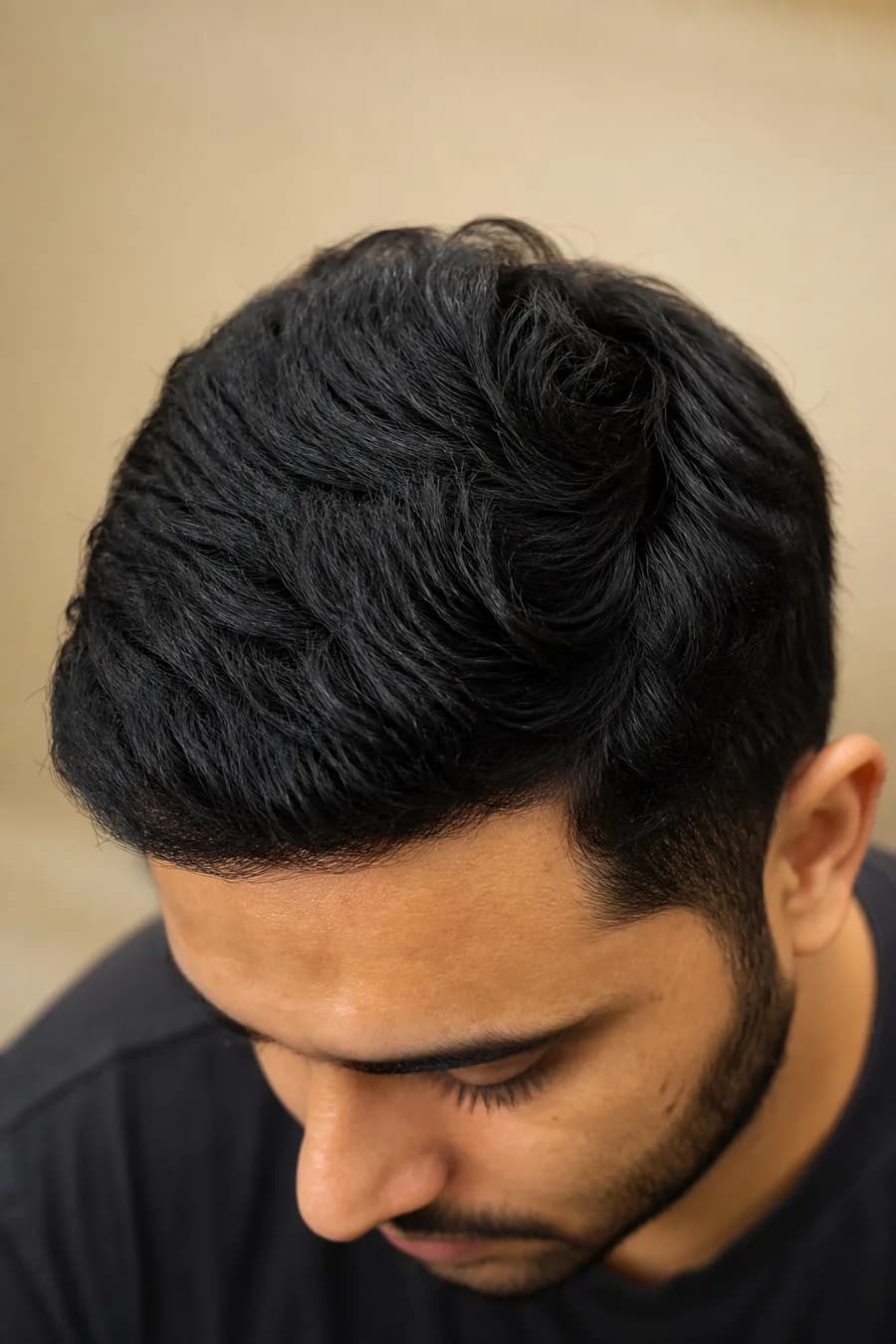 Crown Hair Transplant at MHB Clinic London