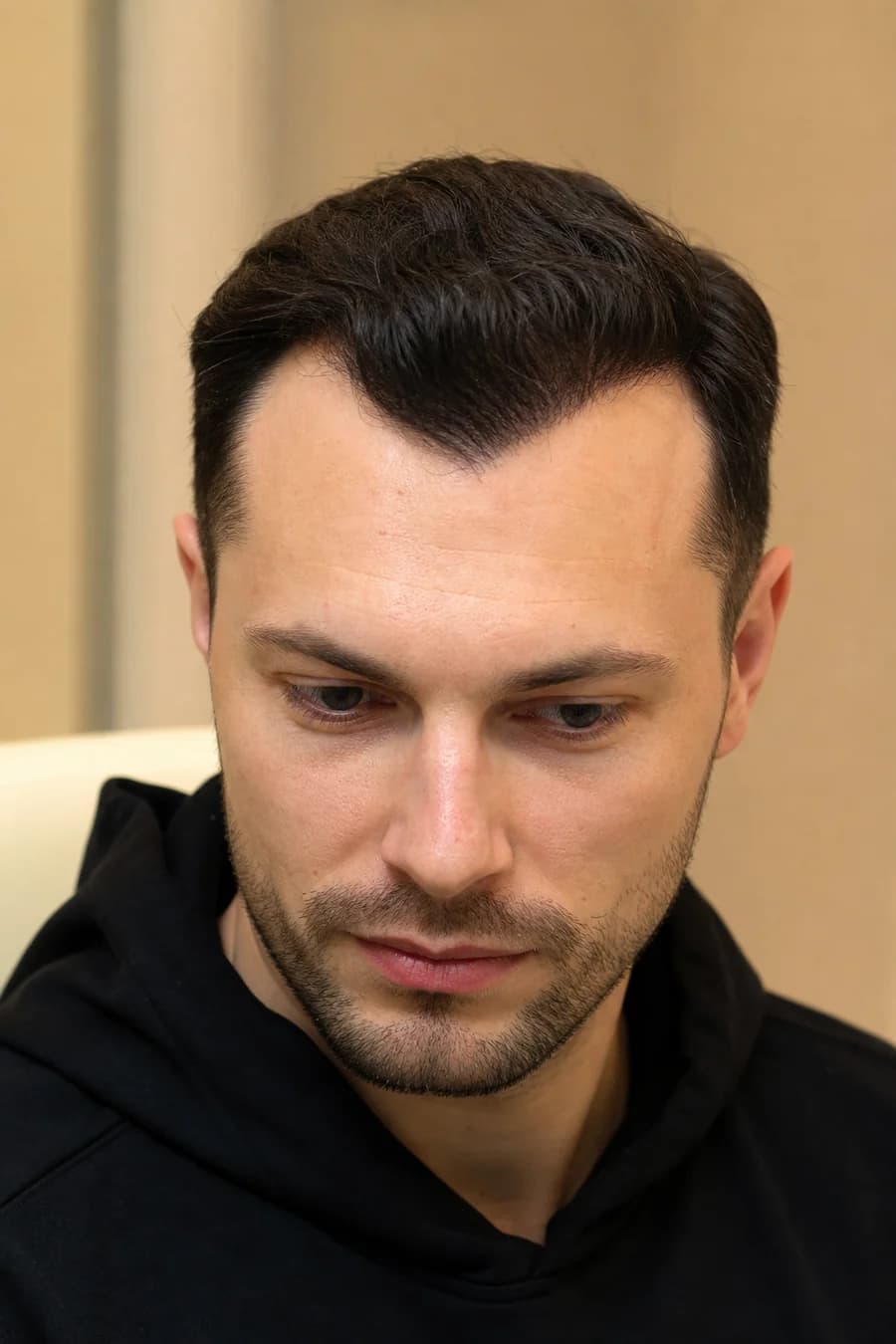 Widow's Peak Hair Transplant at MHB Clinic London
